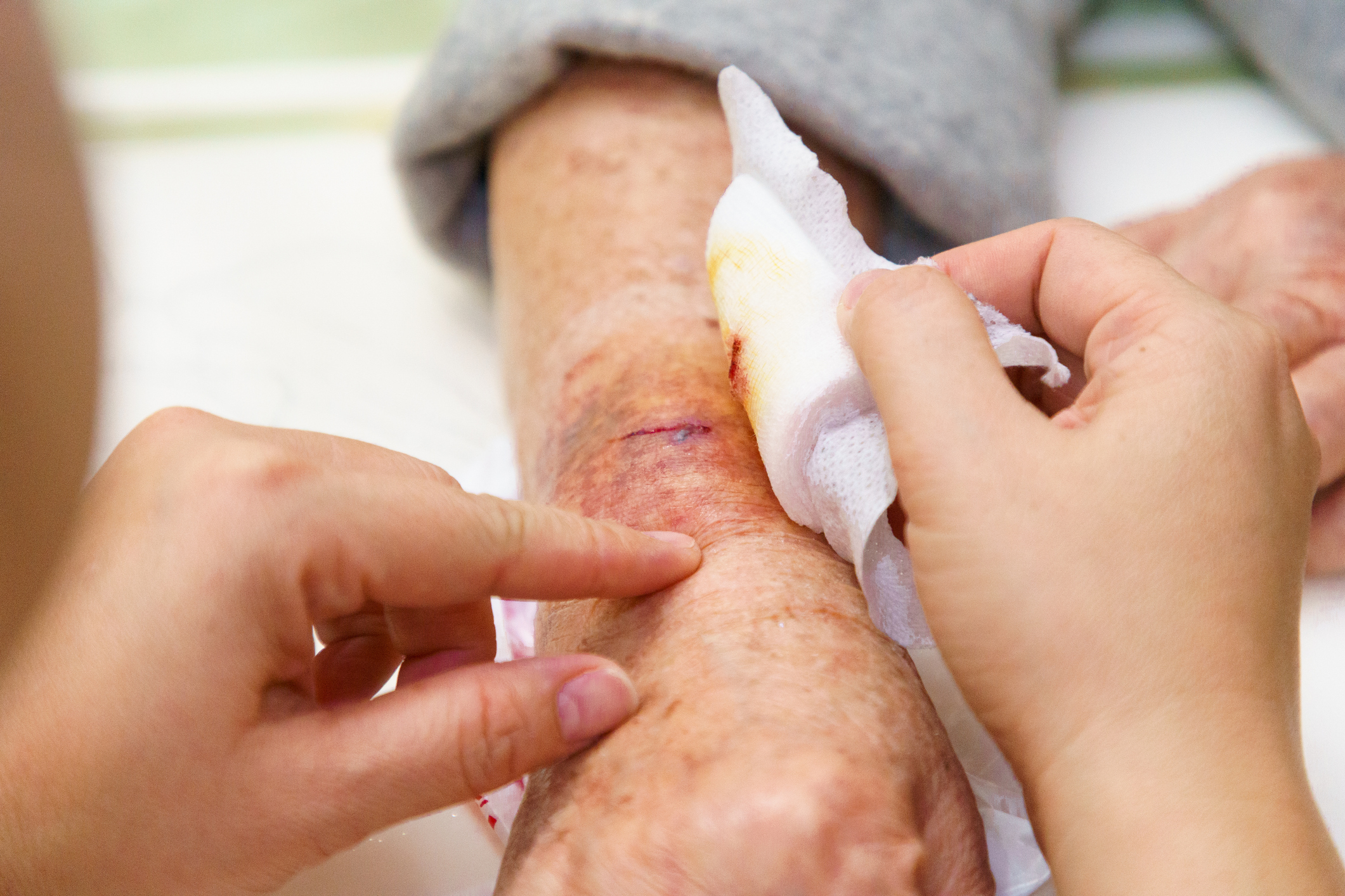 5 Signs a Wound Isn’t Recovering Properly—and What to Do Next